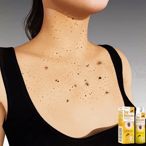 💫PAY FOR 1 TIWORLD™ GET 2 RECEDE TAG 🐝 ⭐⭐⭐⭐⭐ WART AND MOLE SPRAY TREATMENT🐝👨‍⚕
