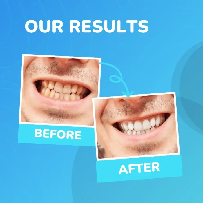 Say Goodbye to Bleeding Gums & Painful Flossing: Clean in 60 Seconds With the LumiSmile Water Flosser