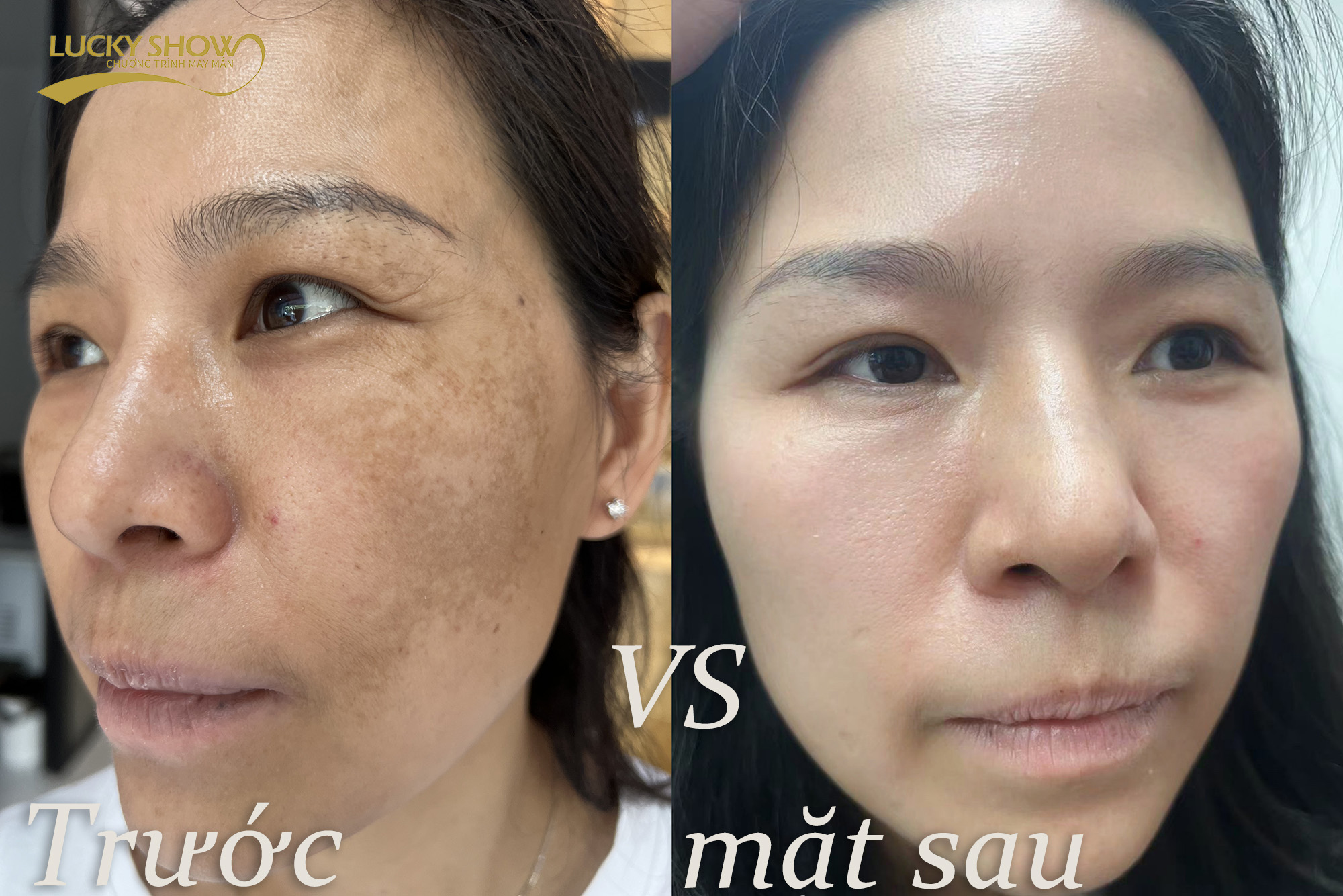 Hình ảnh so sánh trước và sau Lucky Show Beauty điều chỉnh làn da