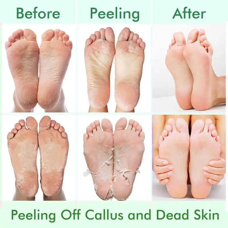 Hand & Foot Peel Mask, Dead Skin Removal