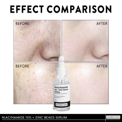 Niacinamide Zinc Beads Serum, Acne & Glow