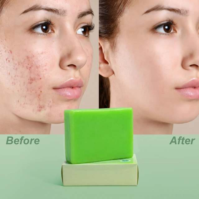 Turmeric Neem Soap –  Acne Care