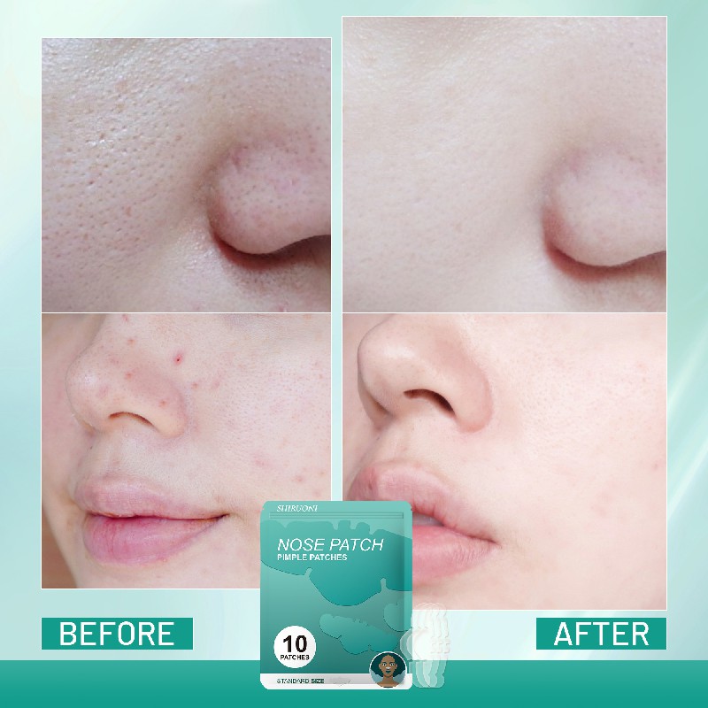 Ingredients & Benefits  10% Glycolic Acid: Gently exfoliates to renew the skin surface and reduce signs of aging.  2% Salicylic Acid: Deeply penetrates pores to clear acne and control oil.  Calendula Extract: Calms and soothes irritated skin.  Green Tea Extract: Antioxidant-rich, protects and rejuvenates skin.  Vitamin C, E, and B5: Nourish and repair skin, promoting brightness and hydration.  Allantoin: Soothes, softens, and protects sensitive skin.