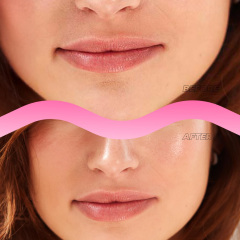 Instant Lip Filler Micro-Darts Patch
