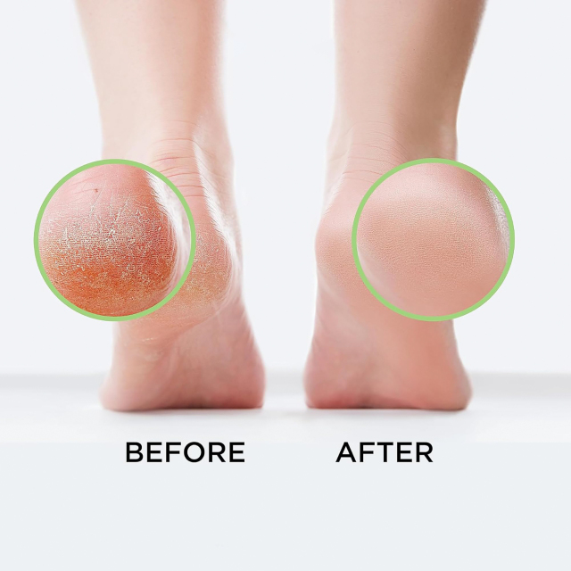 Tea Tree Oil Foot Soak with Dead Sea Salt
