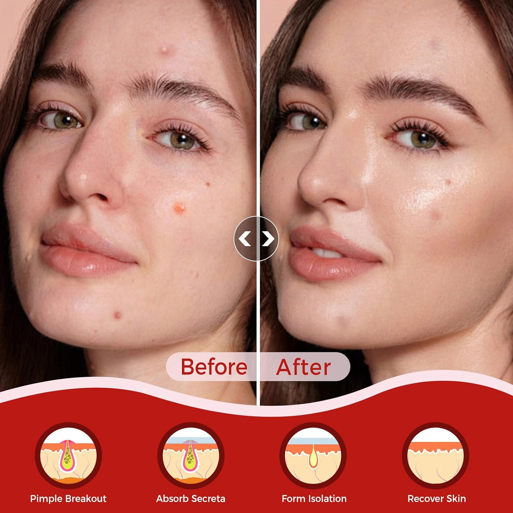Hydrocolloid Acne Patch Set