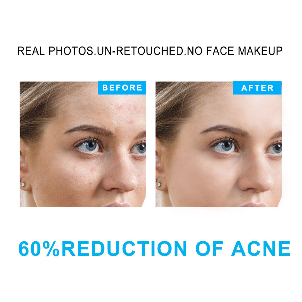 Salicylic Acid Acne Treatment Set