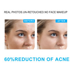 Salicylic Acid Acne Treatment Set