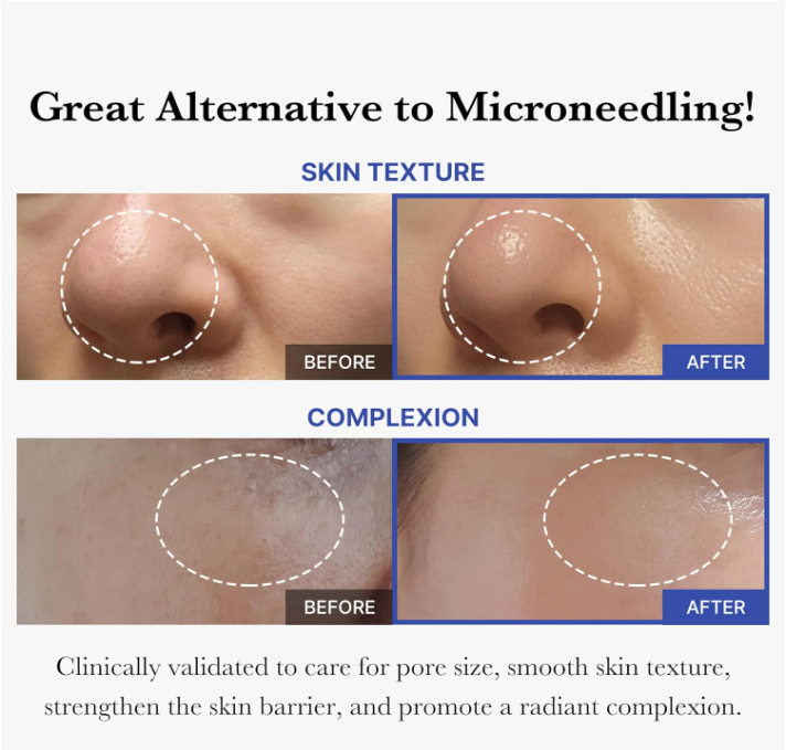 Exosome Microneedle Serum, AHA & BHA & PHA