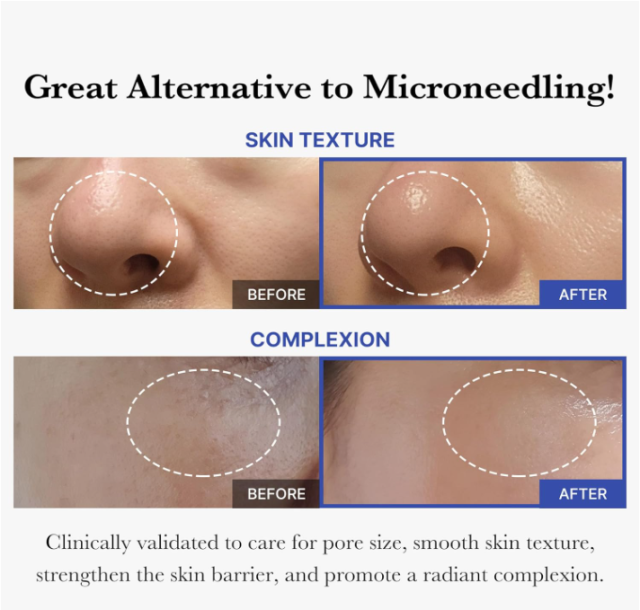 Exosome Microneedle Serum, AHA & BHA & PHA