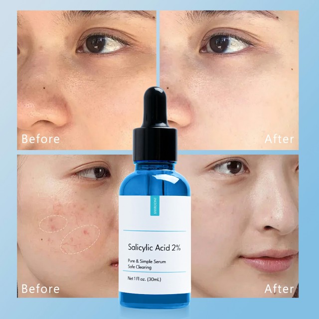 Salicylic Acid Serum, Acne & Oil Control