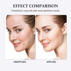 Salicylic Acid Acne Serum