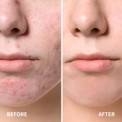 Acne Patch Invisible Spot Cover
