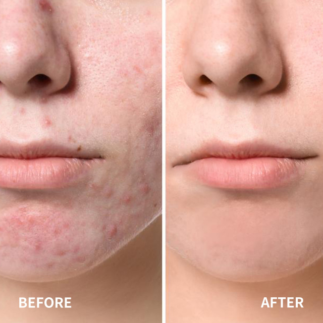 Acne Patch Invisible Spot Cover
