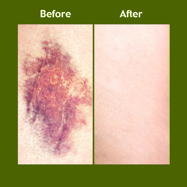 Reduce Bruising Arnica Cream 50G Pain Relief Cream,oalen cosmetics