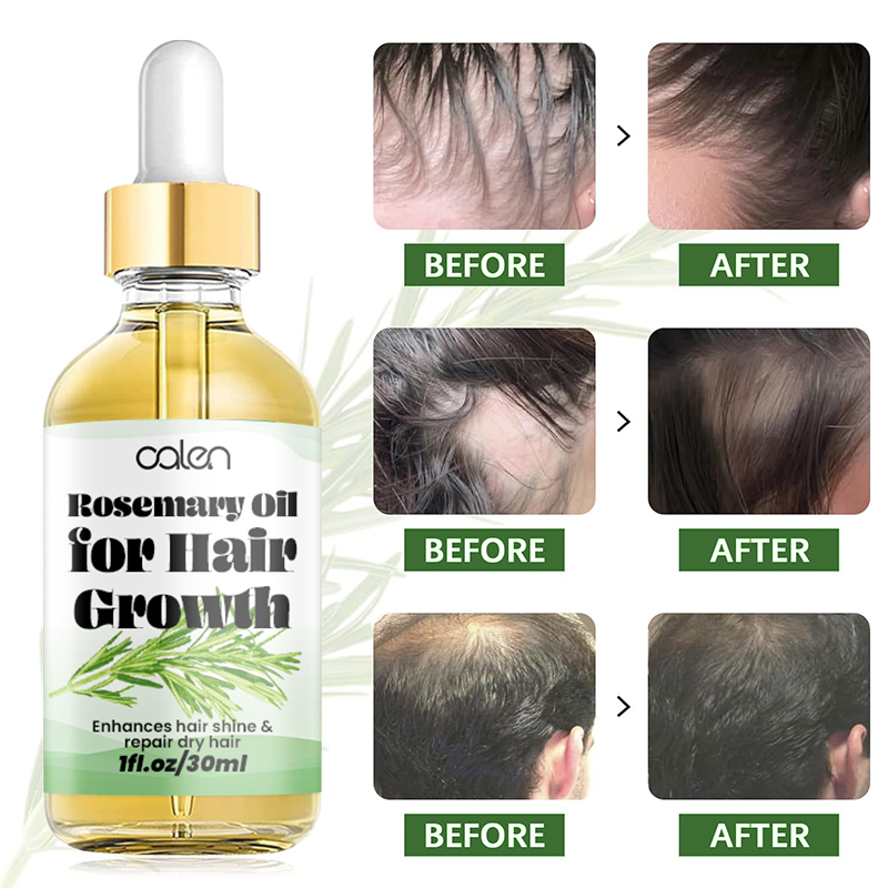 Oalen OEM Enhances Hair Dry Scalp Hair Growth Rosemary Oil,oalen cosmetics