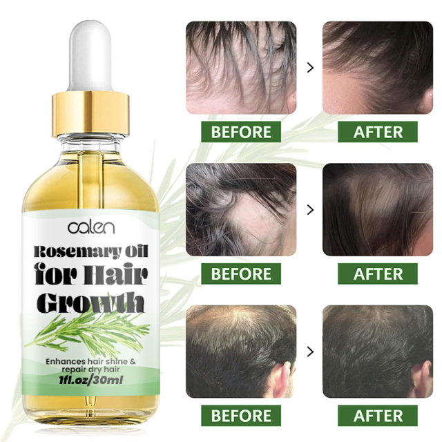 Oalen OEM Enhances Hair Dry Scalp Hair Growth Rosemary Oil,oalen cosmetics