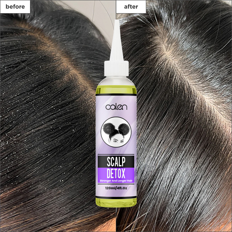 Oalen 120Ml Hair Loss Treatment Scalp Detox Hair Growth Oil,MY SHOP