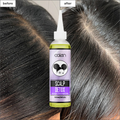 Oalen 120Ml Hair Loss Treatment Scalp Detox Hair Growth Oil,MY SHOP