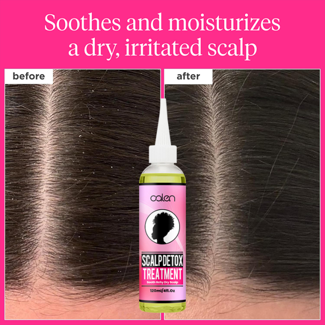 Oalen Custom Pre-Shampoo Scalp Oily Control Soothing Relief Detox,MY SHOP