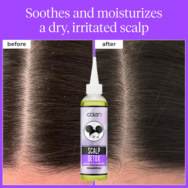 Oalen 120Ml Hair Loss Treatment Scalp Detox Hair Growth Oil,MY SHOP