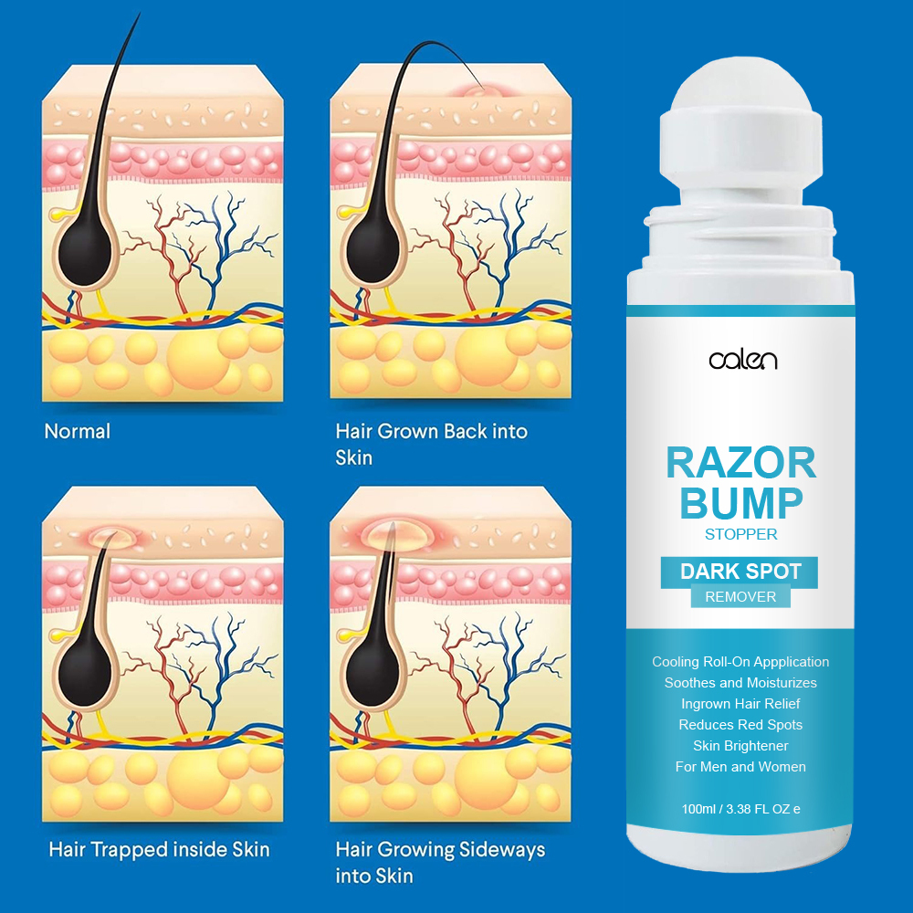 Razor Bump Stopper with Dark Spot Remover, Ingrown Hair Treatment for Bikini Area and Razor Bumps Treatment,MY SHOP