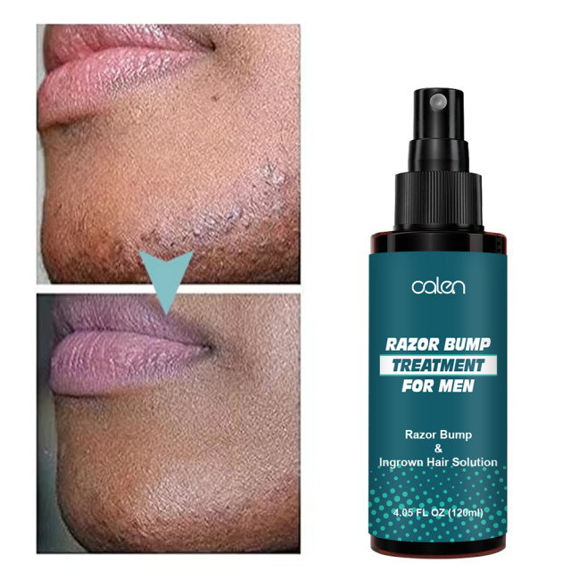 Razor Bump Stopper Ingrown Hair Treatment for Men & Women Razor Burn Relief for Bikini Area After Shave Lotion,oalen cosmetics