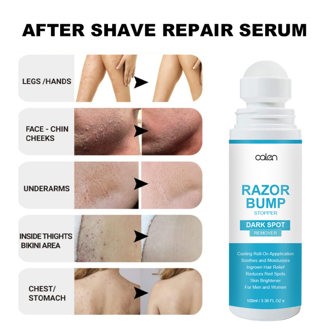Razor Bump Stopper with Dark Spot Remover, Ingrown Hair Treatment for Bikini Area and Razor Bumps Treatment,MY SHOP