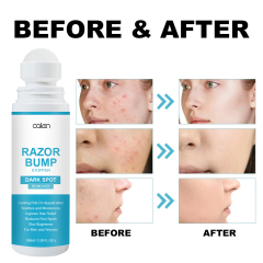Razor Bump Stopper with Dark Spot Remover, Ingrown Hair Treatment for Bikini Area and Razor Bumps Treatment,MY SHOP