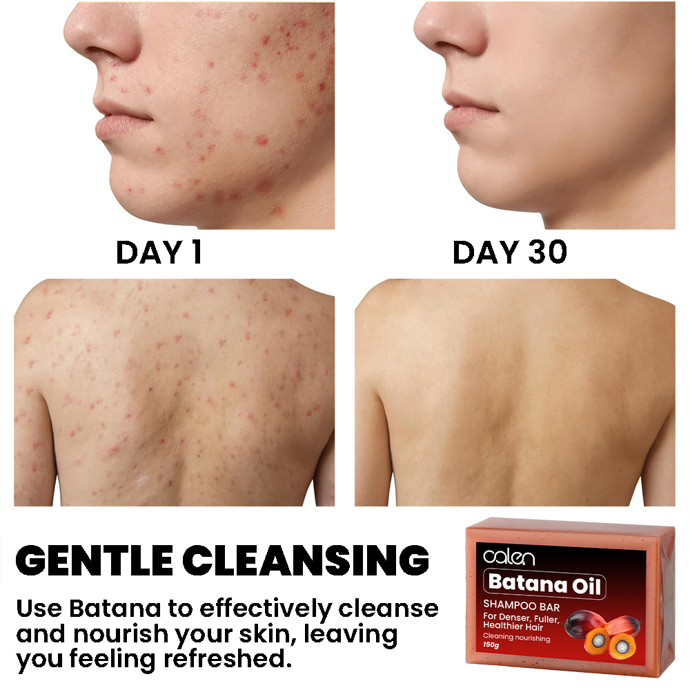 Glowing Soap Natural Ingredients Dark Spot Remover Acne Treatment for Oily Dry Skin Moisturizing Face Body Care,MY SHOP
