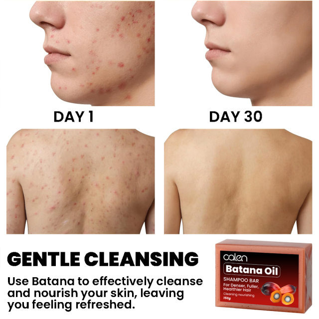 Glowing Soap Natural Ingredients Dark Spot Remover Acne Treatment for Oily Dry Skin Moisturizing Face Body Care,MY SHOP