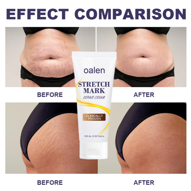 Scar Repair Cream Acne Spot Treatment Stretch Marks Removal Cream Smoothing Firming Moisturizing Skin Care,oalen cosmetics