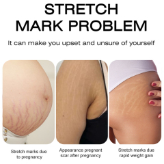 Scar Repair Cream Acne Spot Treatment Stretch Marks Removal Cream Smoothing Firming Moisturizing Skin Care,oalen cosmetics
