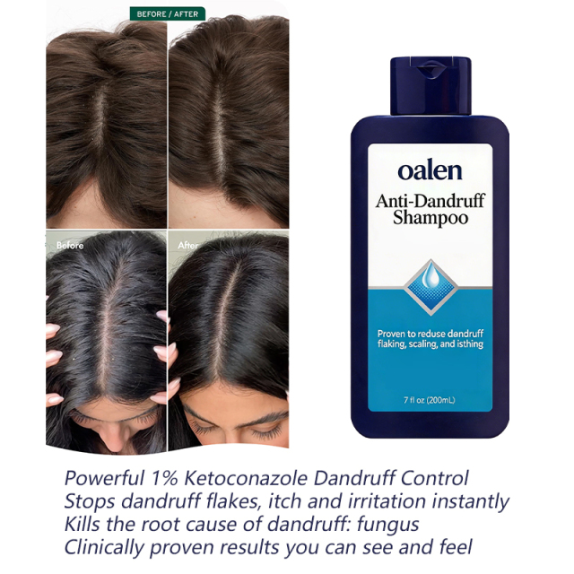 Oalen Private Label Anti-Dandruff Shampoo Clinically Proven 10X Effective Deep Clean Repair Care Scalp Care,oalen cosmetics