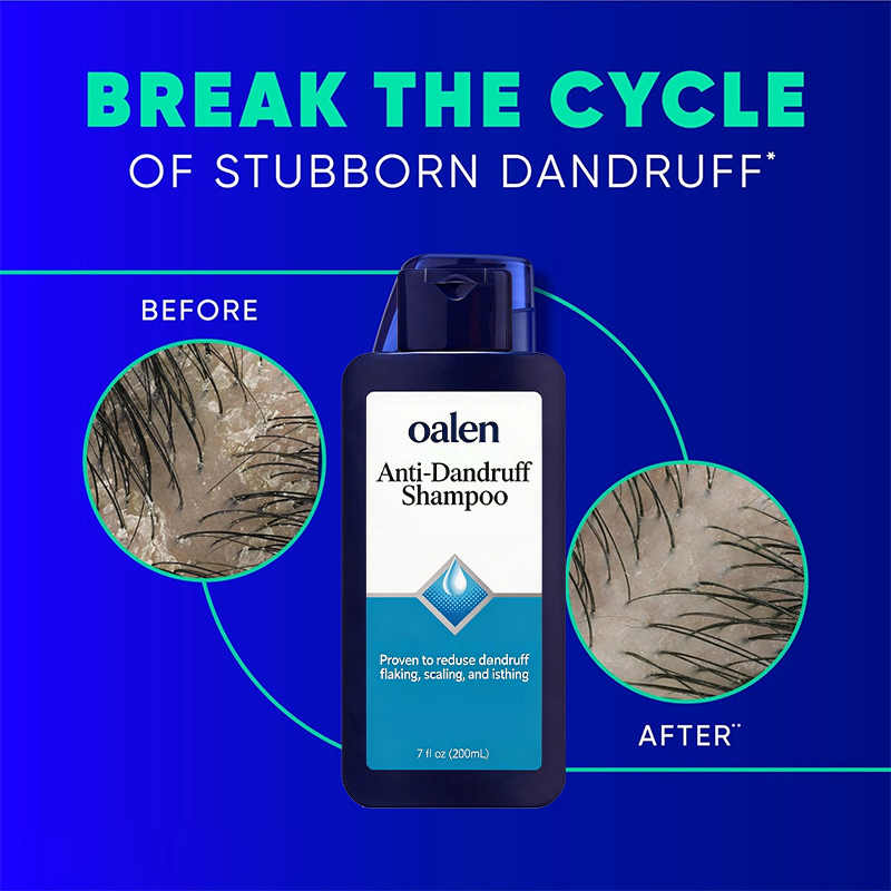 Oalen Private Label Anti-Dandruff Shampoo Clinically Proven 10X Effective Deep Clean Repair Care Scalp Care,oalen cosmetics