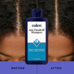 Oalen Private Label Anti-Dandruff Shampoo Clinically Proven 10X Effective Deep Clean Repair Care Scalp Care,oalen cosmetics