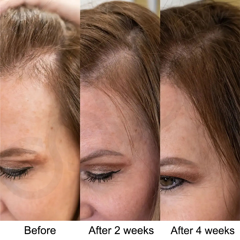 Oalen Natural Hair Regrowth Oil for Receding Hairline, Nourish Sparse Forehead Edges, Strengthen Weak Hair Roots Activate Dormant Follicles Anti Hair Loss Scalp Care Oil,MY SHOP