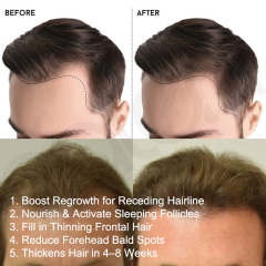 Oalen Natural Hair Regrowth Oil for Receding Hairline, Nourish Sparse Forehead Edges, Strengthen Weak Hair Roots Activate Dormant Follicles Anti Hair Loss Scalp Care Oil,MY SHOP