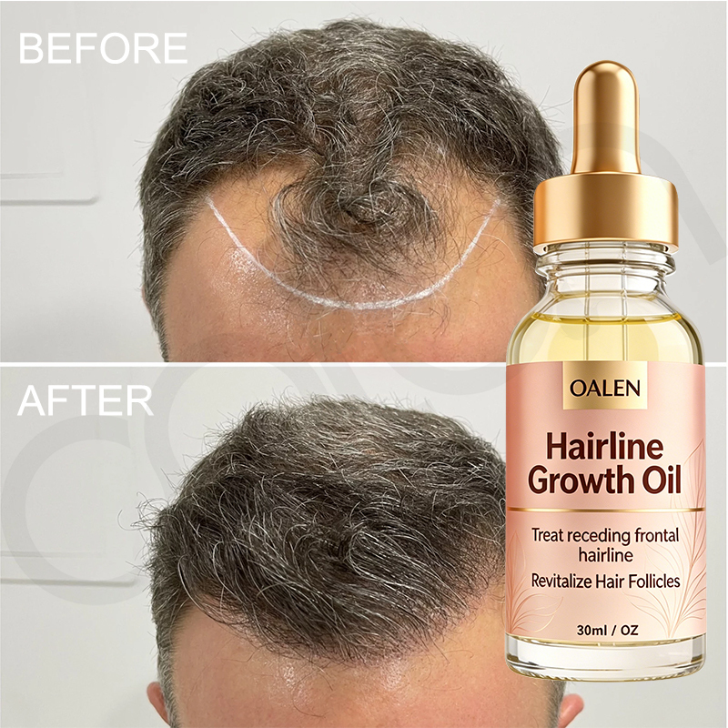 Oalen Natural Hair Regrowth Oil for Receding Hairline, Nourish Sparse Forehead Edges, Strengthen Weak Hair Roots Activate Dormant Follicles Anti Hair Loss Scalp Care Oil,MY SHOP