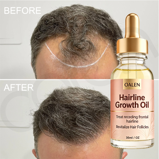 Oalen Natural Hair Regrowth Oil for Receding Hairline, Nourish Sparse Forehead Edges, Strengthen Weak Hair Roots Activate Dormant Follicles Anti Hair Loss Scalp Care Oil,MY SHOP
