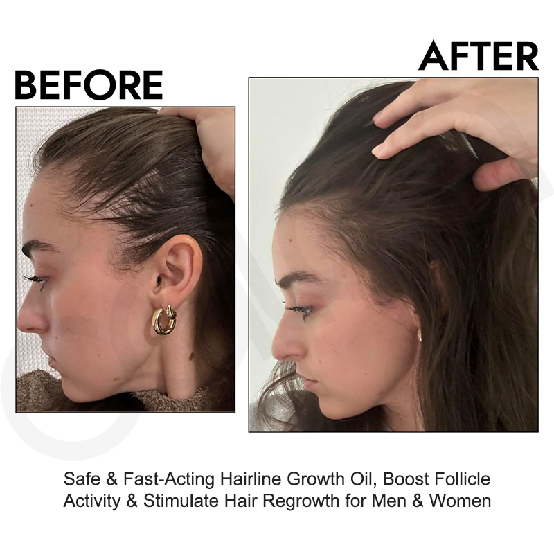 Oalen Natural Hair Regrowth Oil for Receding Hairline, Nourish Sparse Forehead Edges, Strengthen Weak Hair Roots Activate Dormant Follicles Anti Hair Loss Scalp Care Oil,MY SHOP
