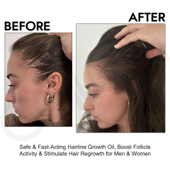 Oalen Natural Hair Regrowth Oil for Receding Hairline, Nourish Sparse Forehead Edges, Strengthen Weak Hair Roots Activate Dormant Follicles Anti Hair Loss Scalp Care Oil,MY SHOP