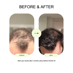 Oalen Hair Growth Serum Roll On, Forehead Hair Regrowth Roller Serum, Anti Hair Loss Scalp Treatment Oil, Nourish Thinning Hair Boost Baby Hair Growth for Men Women 25ml,MY SHOP