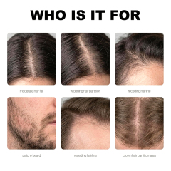 Oalen Hair Growth Serum Roll On, Forehead Hair Regrowth Roller Serum, Anti Hair Loss Scalp Treatment Oil, Nourish Thinning Hair Boost Baby Hair Growth for Men Women 25ml,MY SHOP