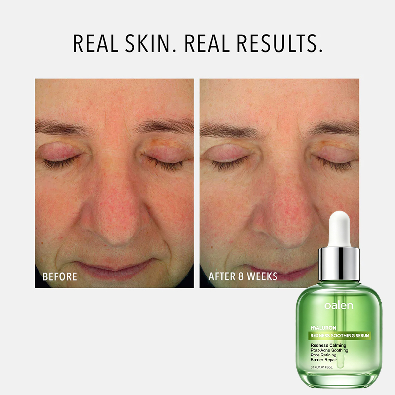 oalen private label azelaic acid serum with hyaluronic acid redness soothing facial care for oily and blemish prone skin lightweight hydrating treatment,MY SHOP