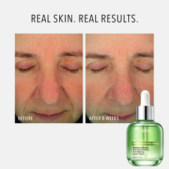 Luxfume Redness Calming Facial Serum Infused with Azelaic Acid and Hyaluronic Acid Gentle Hydrating Care for Blemish Prone Skin,MY SHOP