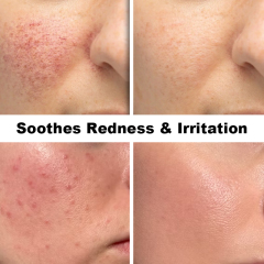 Luxfume Redness Calming Facial Serum Infused with Azelaic Acid and Hyaluronic Acid Gentle Hydrating Care for Blemish Prone Skin,MY SHOP