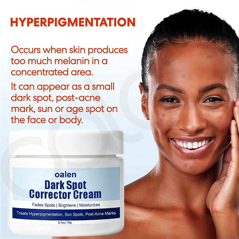 Luxfume Private Label Remove Dark Spot Cream Fade Blemish Marks Brighten Dull Skin Moisturizing Soothing Facial Care,oalen cosmetics