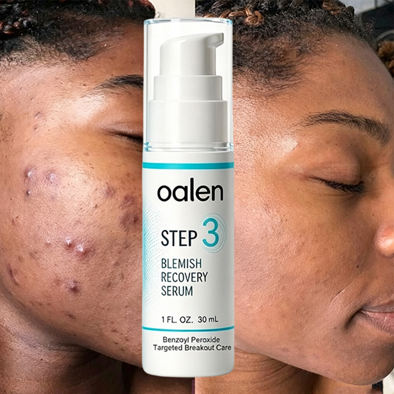 Oalen Private Label 3 Step Acne Care Kit Facial Acne Treatment Set Exfoliating Toner Spot Care 30 Day Complete Facial Skin Care,oalen cosmetics
