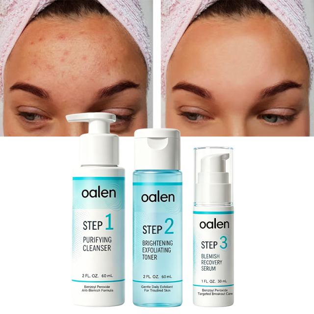 Oalen Private Label 3 Step Acne Care Kit Facial Acne Treatment Set Exfoliating Toner Spot Care 30 Day Complete Facial Skin Care,oalen cosmetics